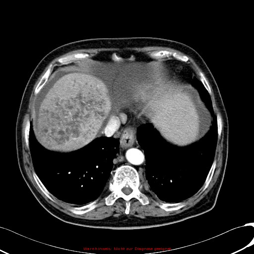 File:Cirrhosis and hepatocellular carcinoma in the setting of hemochromatosis (Radiopaedia 75394-86595 A 18).jpg