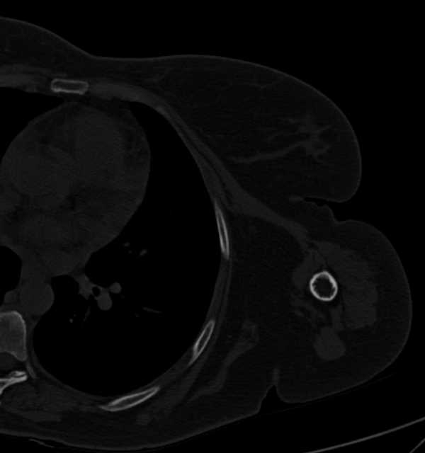 Clear cell chondrosarcoma - humerus (Radiopaedia 63104-71612 Axial bone window 91).jpg