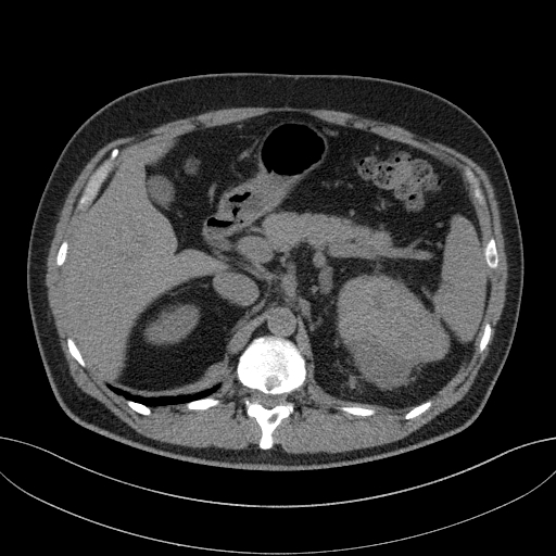 File:Clear cell renal cell carcinoma (Radiopaedia 61449-69393 Axial non-contrast 18).jpg