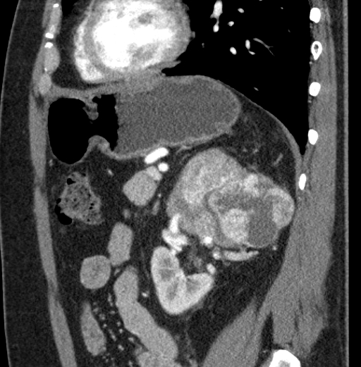 File:Clear cell renal cell carcinoma (Radiopaedia 61449-69393 D 30).jpg