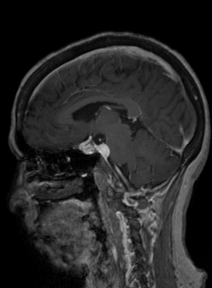 Clival meningioma (Radiopaedia 53278-59248 Sagittal T1 C+ 269).jpg