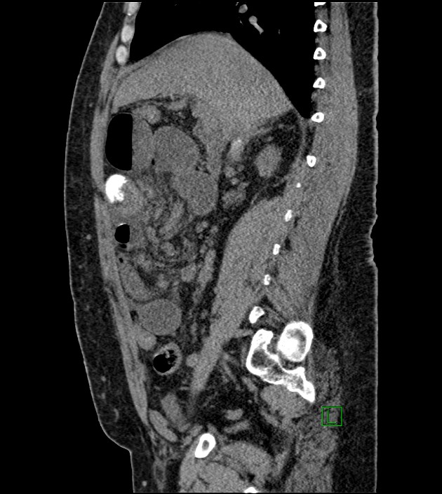 Closed-loop small bowel obstruction-internal hernia (Radiopaedia 78439-91096 C 90).jpg