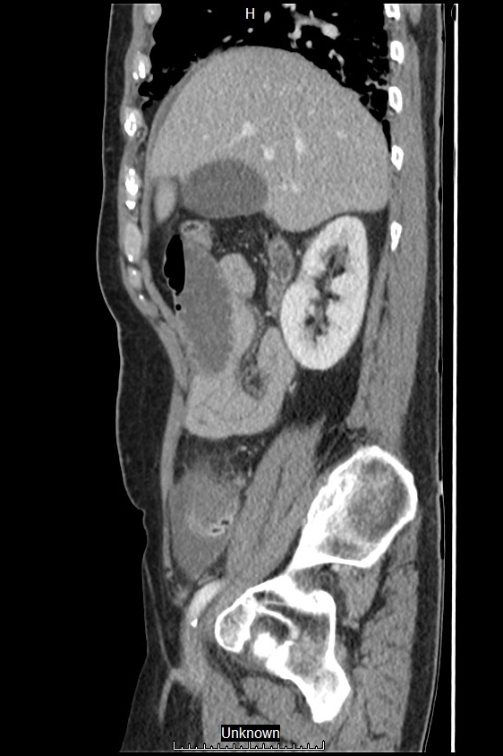 Closed loop bowel obstruction and ischemia (Radiopaedia 86959-103180 C 48).jpg