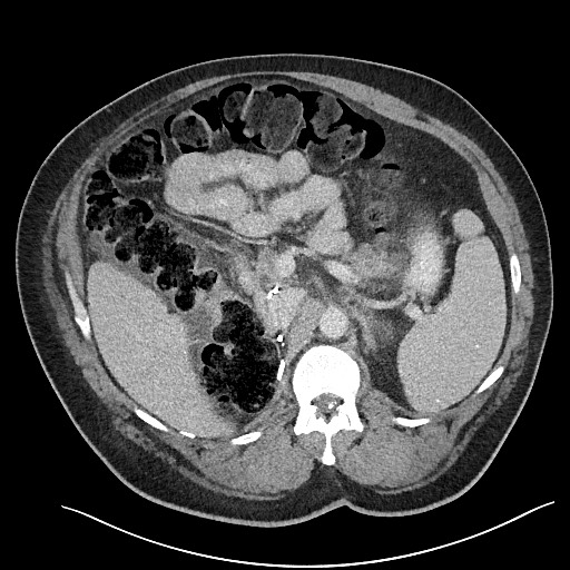 File:Closed loop obstruction - internal hernia into nephrectomy bed (Radiopaedia 59867-67320 A 46).jpg