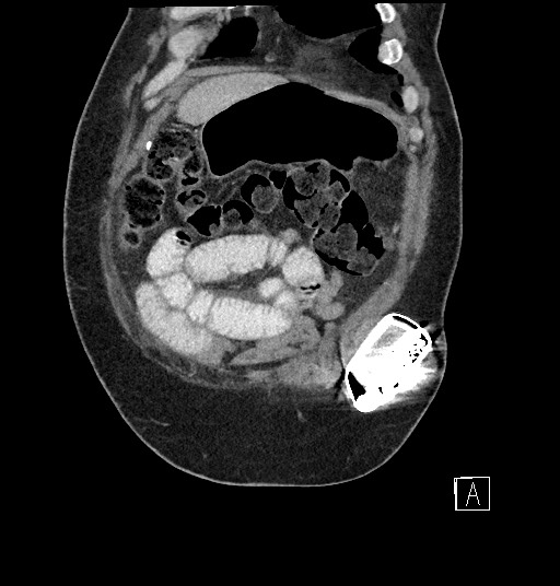 Closed loop obstruction - internal hernia into nephrectomy bed (Radiopaedia 59867-67320 B 14).jpg