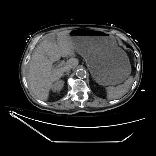 File:Closed loop obstruction due to adhesive band, resulting in small bowel ischemia and resection (Radiopaedia 83835-99023 Axial non-contrast 40).jpg