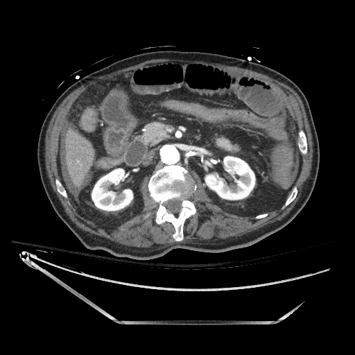 Closed loop obstruction due to adhesive band, resulting in small bowel ischemia and resection (Radiopaedia 83835-99023 B 60).jpg