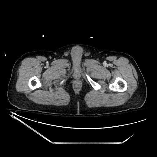 File:Closed loop obstruction due to adhesive band, resulting in small bowel ischemia and resection (Radiopaedia 83835-99023 D 173).jpg