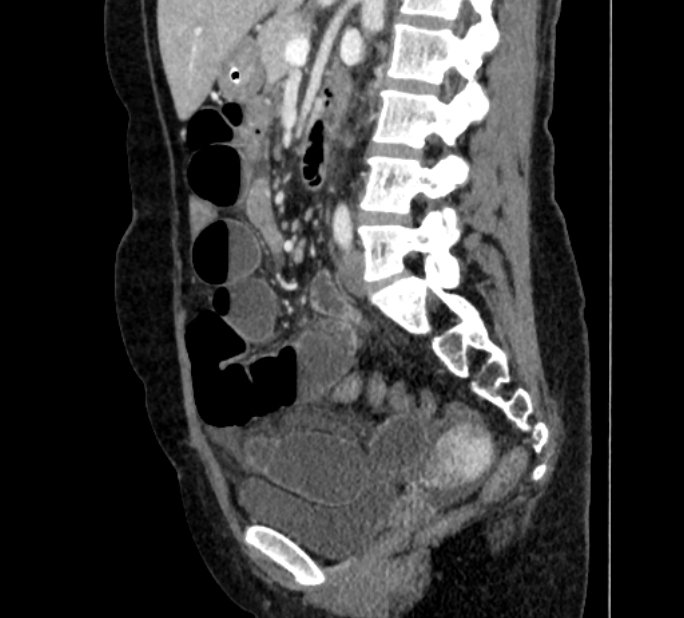 Closed loop small bowel obstruction (Radiopaedia 71211-81508 C 84).jpg