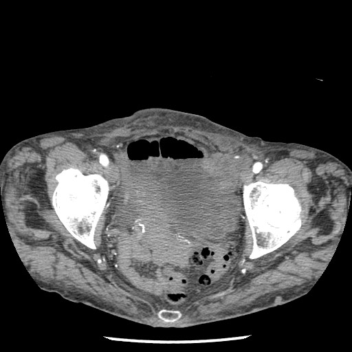 File:Closed loop small bowel obstruction - adhesions and infarct (Radiopaedia 85125-100678 A 182).jpg