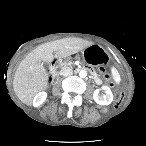 Closed loop small bowel obstruction - adhesions and infarct (Radiopaedia 85125-100678 B 42).jpg