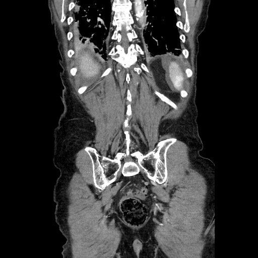 Closed loop small bowel obstruction - adhesive disease and hemorrhagic ischemia (Radiopaedia 86831-102990 B 107).jpg