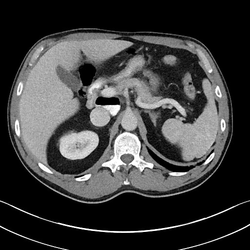File:Closed loop small bowel obstruction - internal hernia (Radiopaedia 57806-64778 Axial 81).jpg