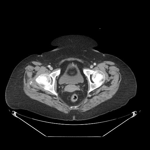 Closed loop small bowel obstruction - internal hernia (Radiopaedia 65402-74450 A 127).jpg