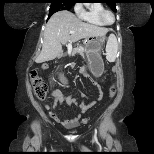 Closed loop small bowel obstruction - internal hernia (Radiopaedia 65402-74450 B 42).jpg