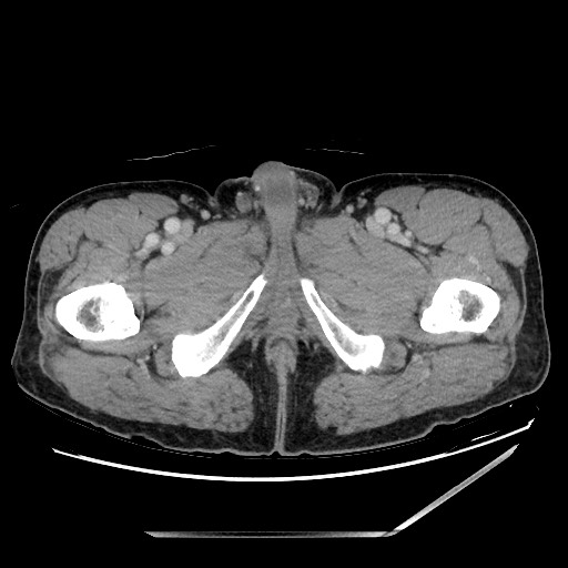 Closed loop small bowel obstruction - omental adhesion causing "internal hernia" (Radiopaedia 85129-100682 A 186).jpg
