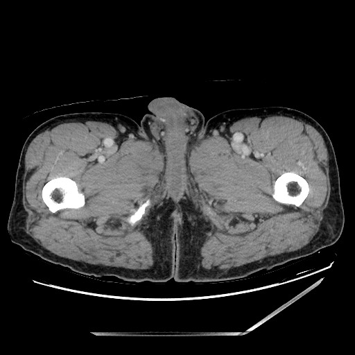 Closed loop small bowel obstruction - omental adhesion causing "internal hernia" (Radiopaedia 85129-100682 A 192).jpg