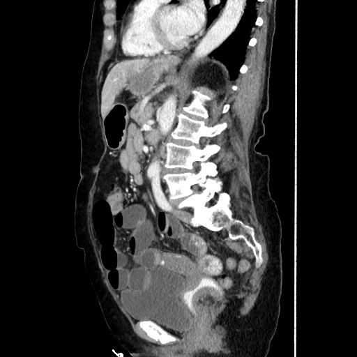 Closed loop small bowel obstruction due to adhesive band, with intramural hemorrhage and ischemia (Radiopaedia 83831-99017 D 114).jpg