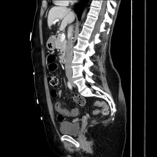 File:Closed loop small bowel obstruction due to adhesive bands - early and late images (Radiopaedia 83830-99014 C 88).jpg