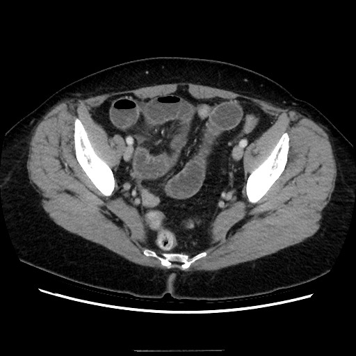 Closed loop small bowel obstruction due to adhesive bands - early and late images (Radiopaedia 83830-99015 A 140).jpg
