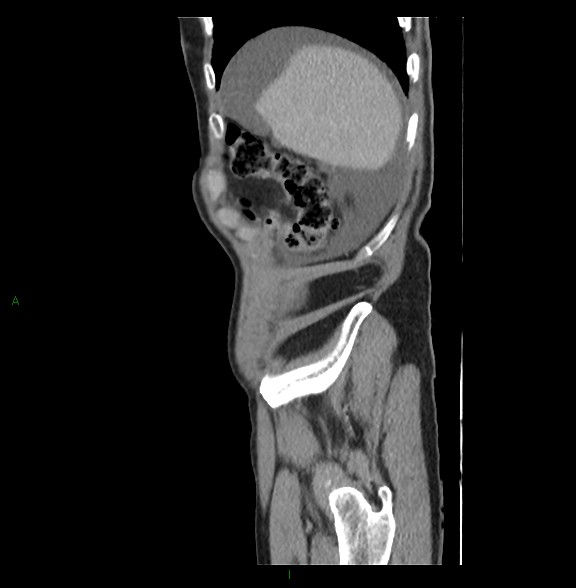 Closed loop small bowel obstruction with ischemia (Radiopaedia 84180-99456 C 14).jpg