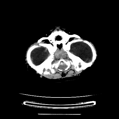 File:Cloverleaf skull (Radiopaedia 91901-109710 Axial non-contrast 45).jpg