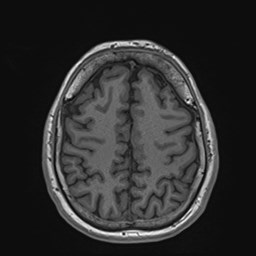File:Cochlear incomplete partition type III associated with hypothalamic hamartoma (Radiopaedia 88756-105498 Axial T1 147).jpg