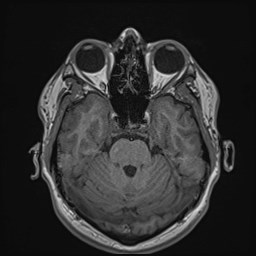 Cochlear incomplete partition type III associated with hypothalamic hamartoma (Radiopaedia 88756-105498 Axial T1 71).jpg