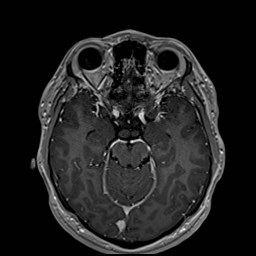 Cochlear incomplete partition type III associated with hypothalamic hamartoma (Radiopaedia 88756-105498 Axial T1 C+ 82).jpg
