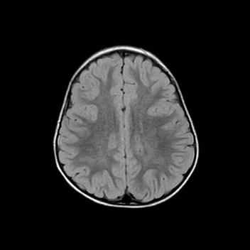 File:Cochlear nerve aplasia - unilateral (Radiopaedia 87910-104413 Axial FLAIR 25).jpg