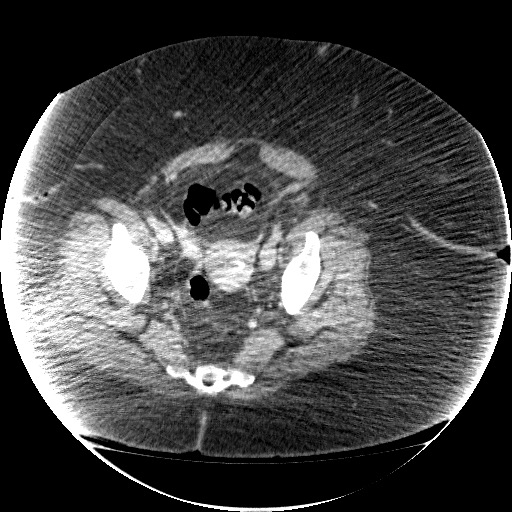 File:Collection due to leak after sleeve gastrectomy (Radiopaedia 55504-61972 A 70).jpg