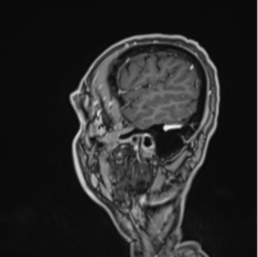 File:Colloid cyst of the third ventricle (Radiopaedia 86571-102662 Sagittal T1 C+ 11).png