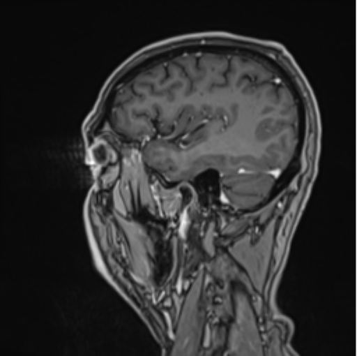File:Colloid cyst of the third ventricle (Radiopaedia 86571-102662 Sagittal T1 C+ 18).png