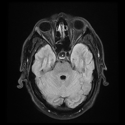 File:Colloid cyst with anterior communicating artery aneurysm (Radiopaedia 33901-35091 Axial FLAIR 7).jpg