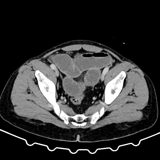 Colocolic intussusception due to large lipoma (Radiopaedia 68773-78482 A 165).jpg