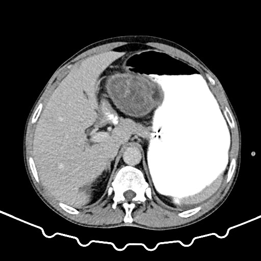 Colocolic intussusception due to large lipoma (Radiopaedia 68773-78482 A 37).jpg