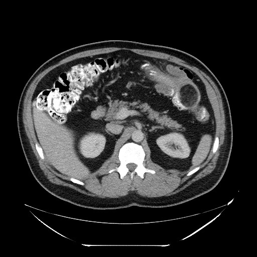 Colocolic intussusception due to lipoma (Radiopaedia 73712-84508 A 39).jpg