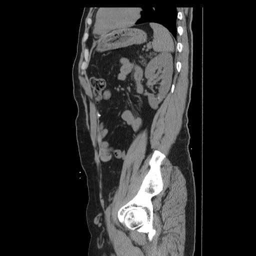 File:Colocutaneous fistula in Crohn's disease (Radiopaedia 29586-30093 C 44).jpg