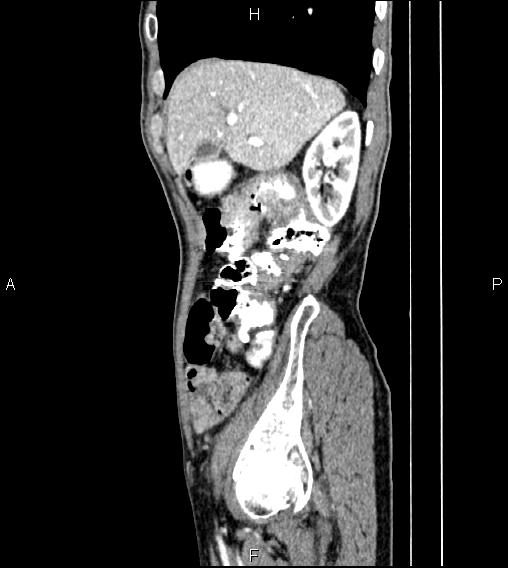 File:Colon adenocarcinoma - hepatic flexure (Radiopaedia 85635-101395 D 20).jpg