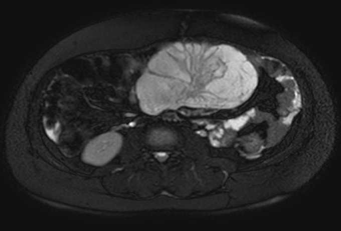 File:Colon adenocarcinoma with Krukenberg tumors, advanced pregnancy (Radiopaedia 67279-76645 Axial T2 SPAIR 42).jpg