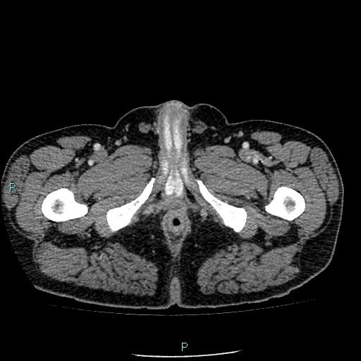 Colon adenocarcinoma with calcific liver metastasis (Radiopaedia 55745-62300 B 52).jpg
