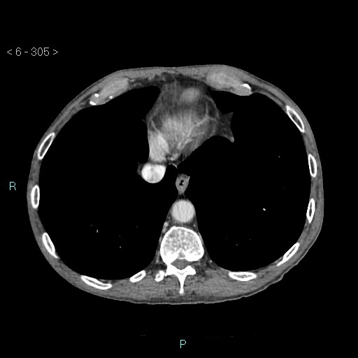File:Colonic cancer (ultrasound and TC imaging) (Radiopaedia 50346-55713 B 305).jpg