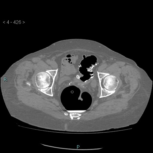 Colonic lipomas (Radiopaedia 49137-54244 Axial bone window 190).jpg