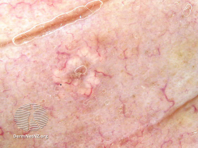File:Dermoscopy view (DermNet NZ acne-sebhpl1).jpg