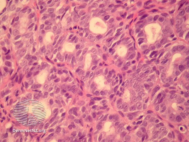 File:Figure 4 (DermNet NZ pathology-e-aggressive-adenocarcinoma-fig4).jpg