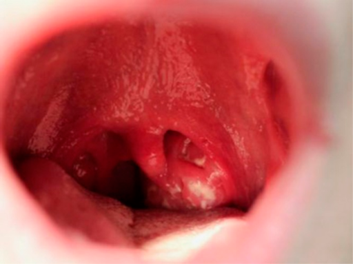 File:Infectious mononucleosis throat.png