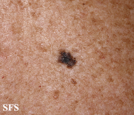 File:Melanoma (Dermatology Atlas 58).jpg