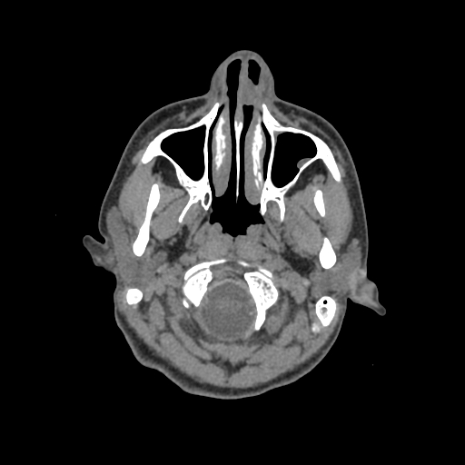 Nasal pyogenic granuloma (lobular capillary hemangioma) (Radiopaedia 85536-101244 Axial non-contrast 25).jpg