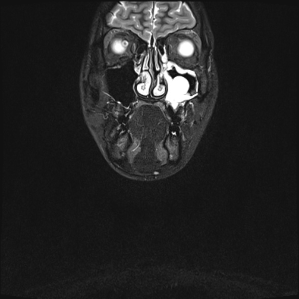 Nasopharyngeal carcinoma with skull base invasion (Radiopaedia 53415-59485 Coronal T2 fat sat 34).jpg