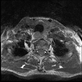 File:Nasopharyngeal carcinoma with skull base invasion (Radiopaedia 59258-66600 Axial T1 20).jpg